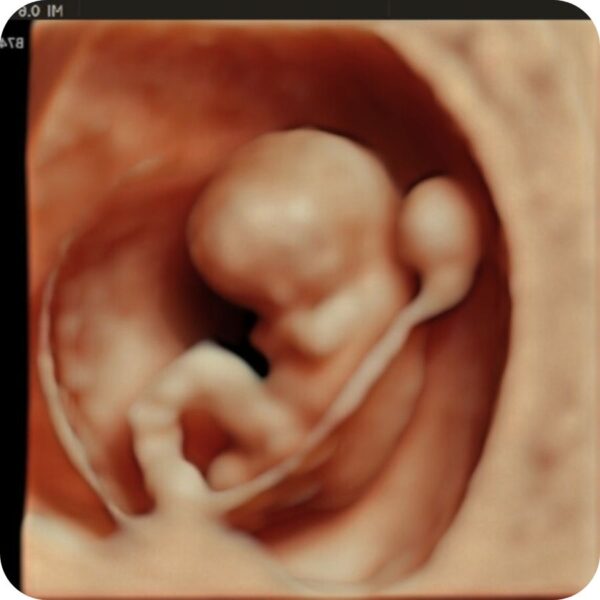 Early Pregnancy Scan 6 12 Weeks Herview Ultrasound