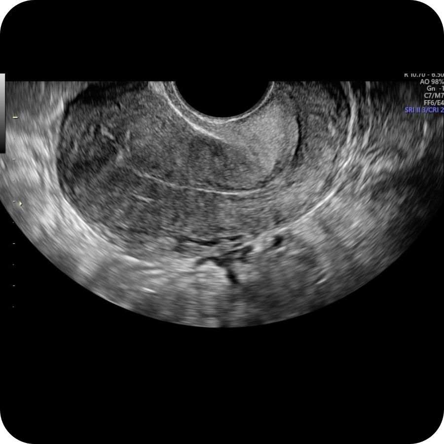 Early Pregnancy Scan (5-12 Weeks)