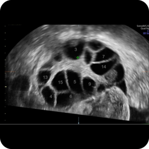 Follicle Tracking