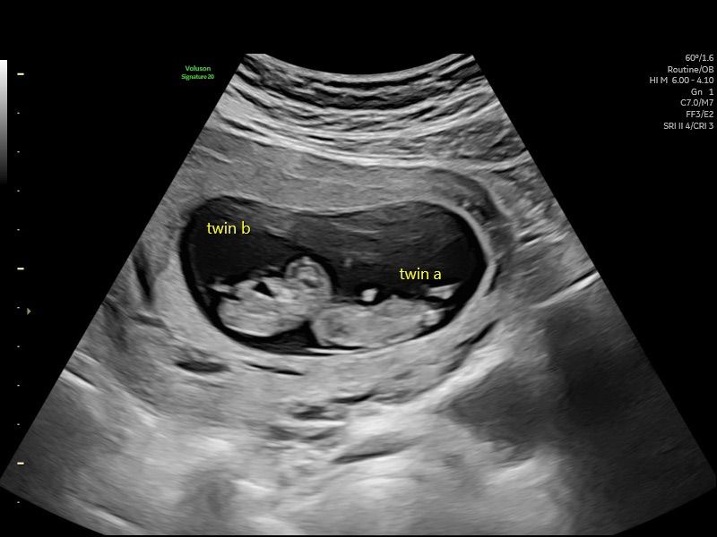 Early Pregnancy Scan (5-12 Weeks)