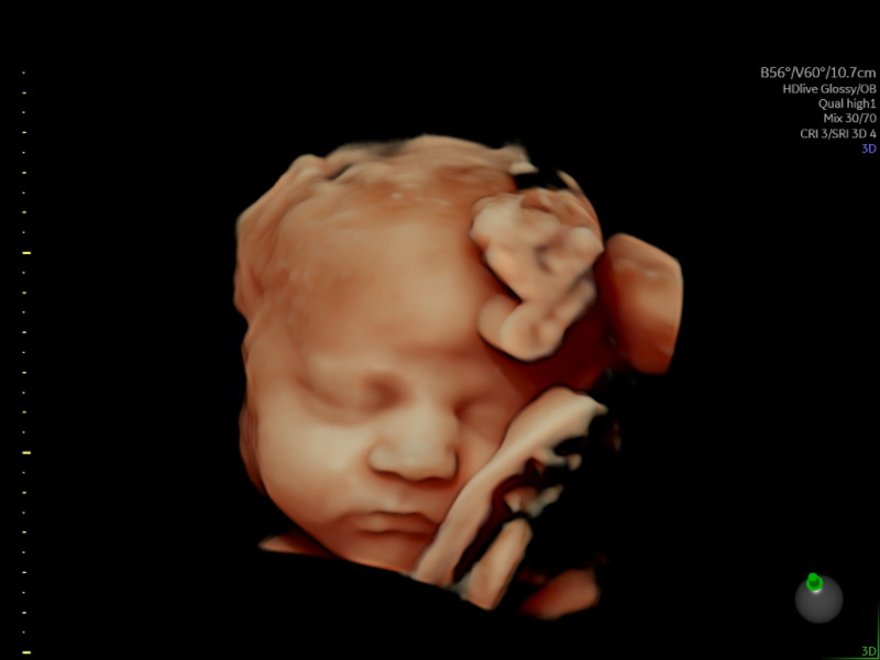 HerView Premium 3D/4D/HD Growth and Wellbeing Scan (22-34 Weeks)