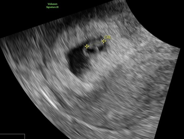 What to Expect at Your 6 Week Pregnancy Scan with HerView Ultrasound