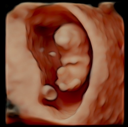 Early Pregnancy Bleeding: Everything You Need to Know