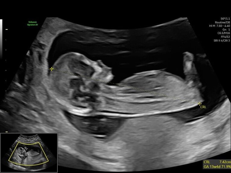 Hyperemesis Gravidarum: A HerView Ultrasound Guide for Expecting Families in Ireland