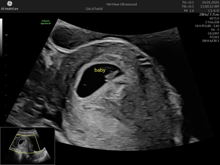 What Will I See at My First Pregnancy Scan?